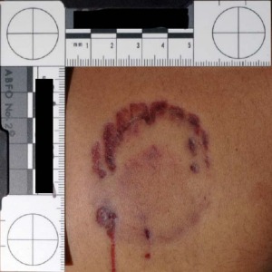 Florida victim's bite mark later matched to Bundy's dental impression.